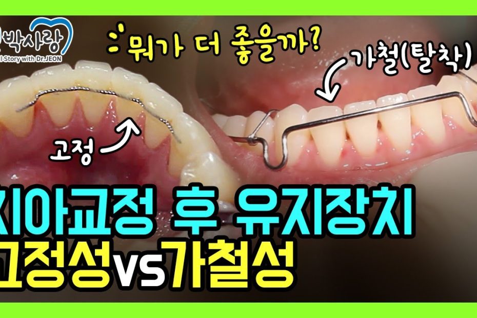 2-37. 치아교정 후 유지장치 뭐가 더 좋을까요? 한 번에 이해되실 겁니다. ⭐치아교정 부작용 막기⭐