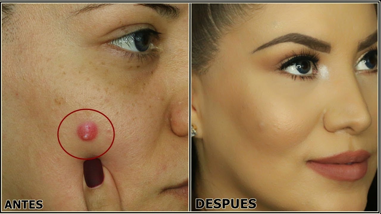 Cómo disimular granos con maquillaje sin dañar la piel